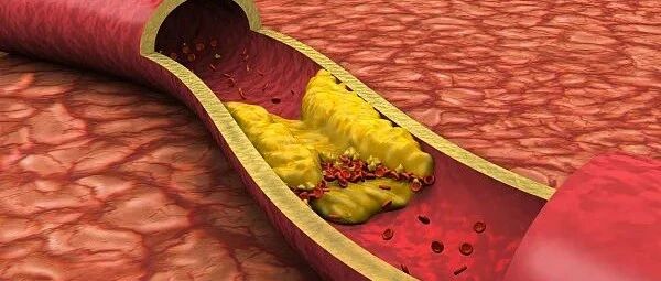 身体这三个部位疼痛要警惕！可能是血管堵了