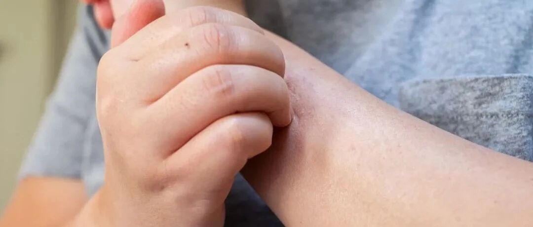 皮肤干燥裂纹可能是病了？专家提到的这些情况莫大意