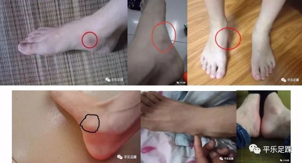 脚内侧有个小鼓包,还肿还痛,咋回事? - 好大夫在线