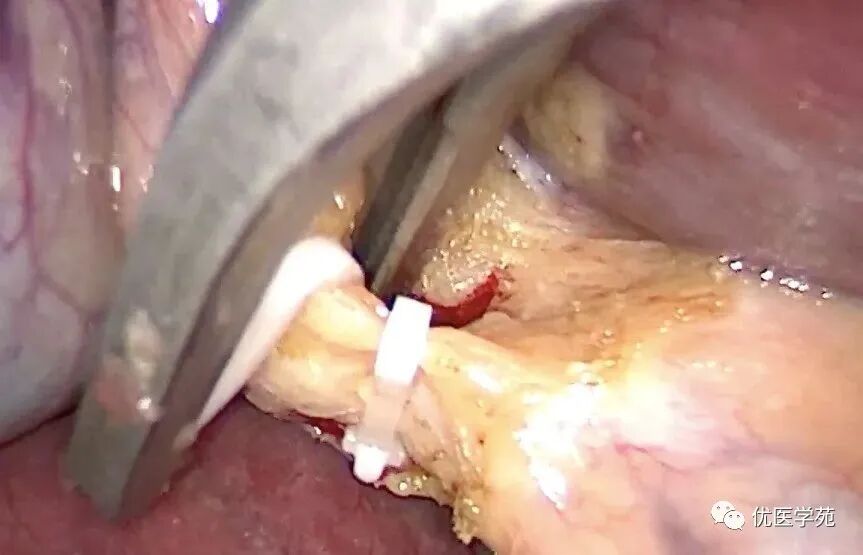 为什么手术会用到结扎夹手术兵器谱篇——止血夹之Hemolok夹，您用对了吗_https://www.jmylbn.com_新闻资讯_第4张