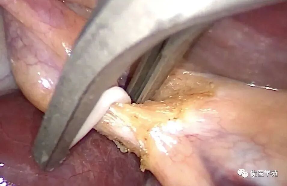 为什么手术会用到结扎夹手术兵器谱篇——止血夹之Hemolok夹，您用对了吗_https://www.jmylbn.com_新闻资讯_第3张