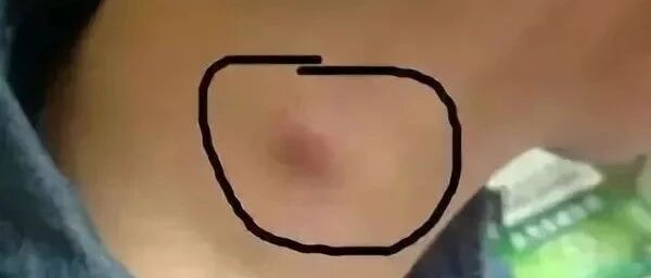 脖子上出现这3种东西，说明癌细胞已经醒了？（附十张最便宜的防癌处方）