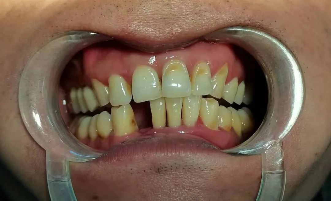 前牙缺失马里兰桥也是一种选择方式