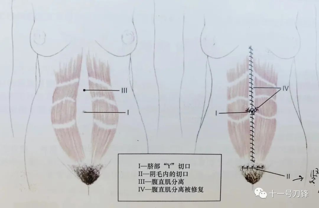 【腹壁整形】详解内窥镜腹壁整形术