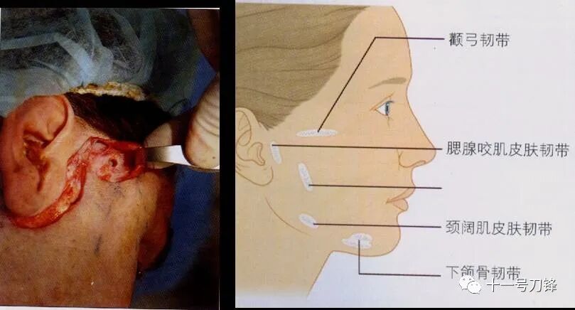 s拉钩怎么用【面部提升】S-面部提升技术（面、颈部小切口面部提升术）_https://www.jmylbn.com_新闻资讯_第3张