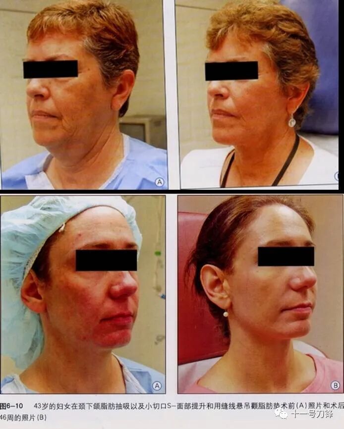 s拉钩怎么用【面部提升】S-面部提升技术（面、颈部小切口面部提升术）_https://www.jmylbn.com_新闻资讯_第5张