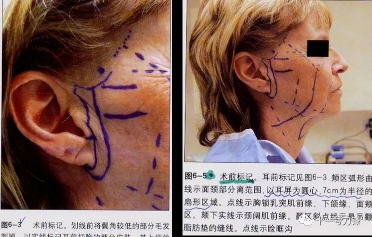 s拉钩怎么用【面部提升】S-面部提升技术（面、颈部小切口面部提升术）_https://www.jmylbn.com_新闻资讯_第2张