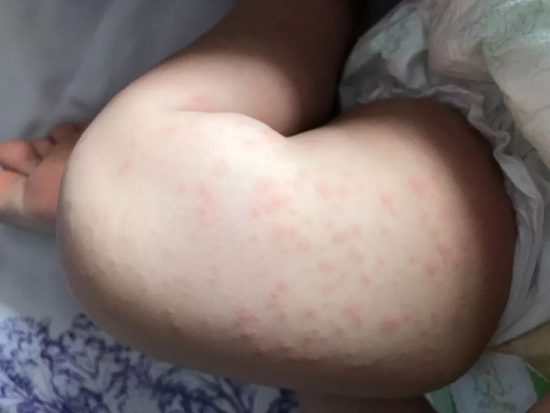 别慌 2岁前宝宝突然高烧，大部分都是因为它——可自愈的"幼儿急疹"