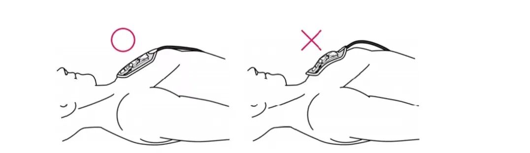 什么是aed除颤【急救科普】自动体外除颤器（AED）使用及注意事项_https://www.jmylbn.com_新闻资讯_第12张