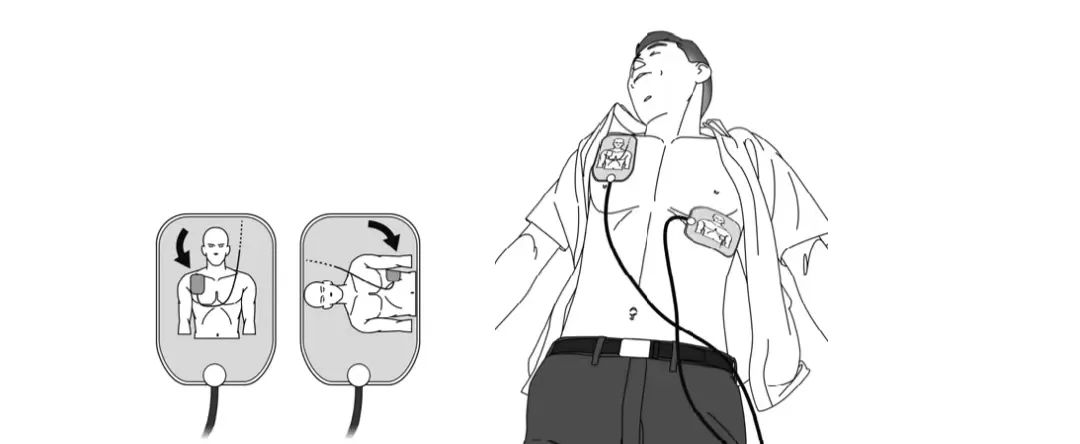 什么是aed除颤【急救科普】自动体外除颤器（AED）使用及注意事项_https://www.jmylbn.com_新闻资讯_第10张