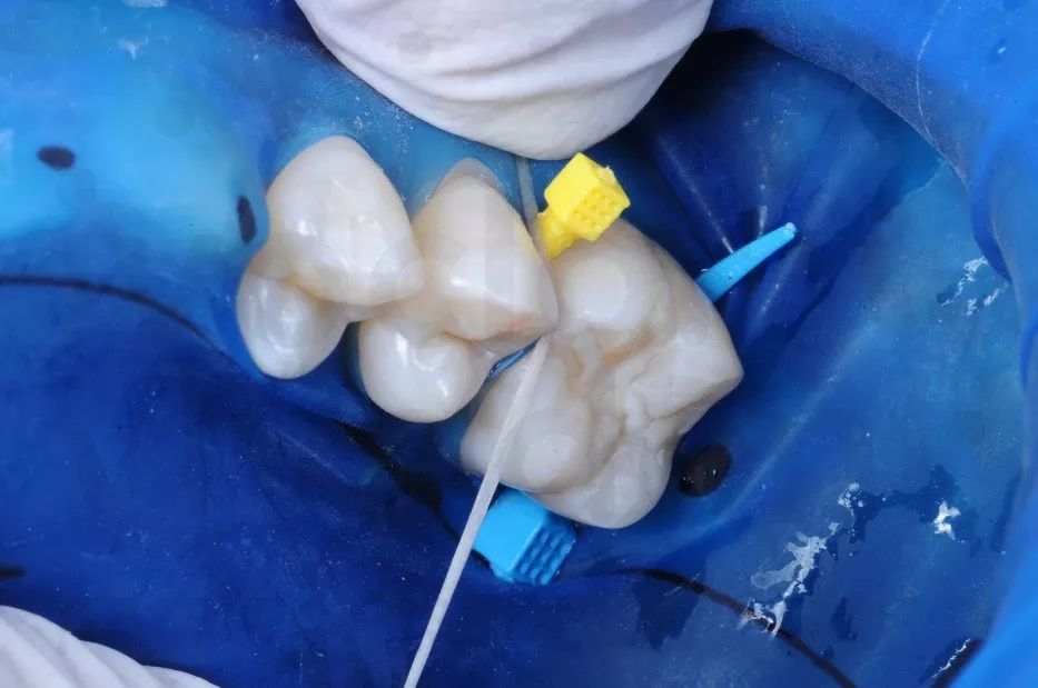 口腔光固化灯是什么光最全的树脂知识都在这了_https://www.jmylbn.com_新闻资讯_第8张