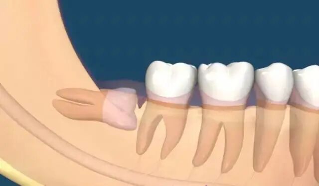 为什么大部分智齿需要拔除？