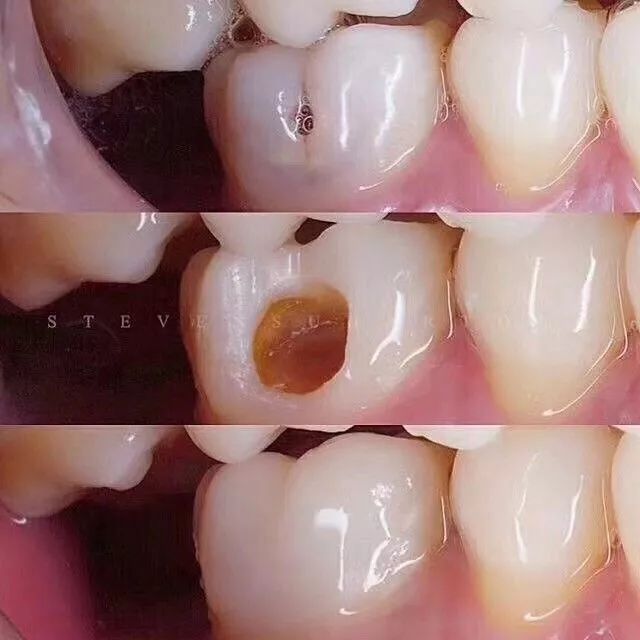 拔烂掉的牙根多少钱_烂牙根一般几年内必须拔_拔烂牙根有危险吗