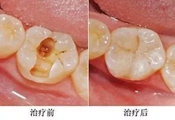 拔烂牙根有危险吗_拔烂掉的牙根多少钱_烂牙根一般几年内必须拔