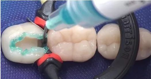 拔烂掉的牙根多少钱_烂牙根一般几年内必须拔_拔烂牙根有危险吗