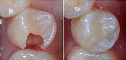烂牙根一般几年内必须拔_拔烂掉的牙根多少钱_拔烂牙根有危险吗