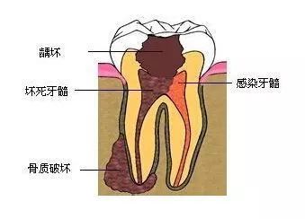 拔烂牙根有危险吗_烂牙根一般几年内必须拔_拔烂掉的牙根多少钱