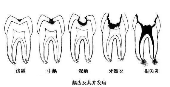 拔烂牙根有危险吗_拔烂掉的牙根多少钱_烂牙根一般几年内必须拔
