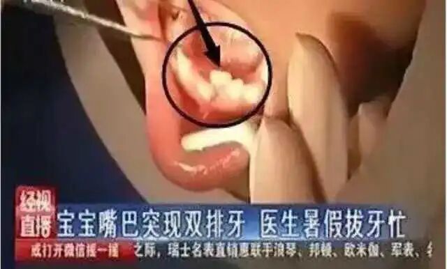 牙医拔牙到手软：每天接诊20个双排牙孩子，请家长先停止“宠溺