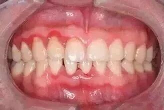 牙龈出现白脓包，该怎么处理