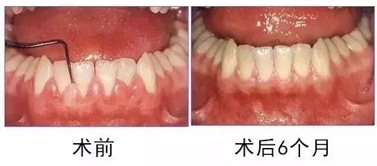 牙龈出现白脓包，该怎么处理