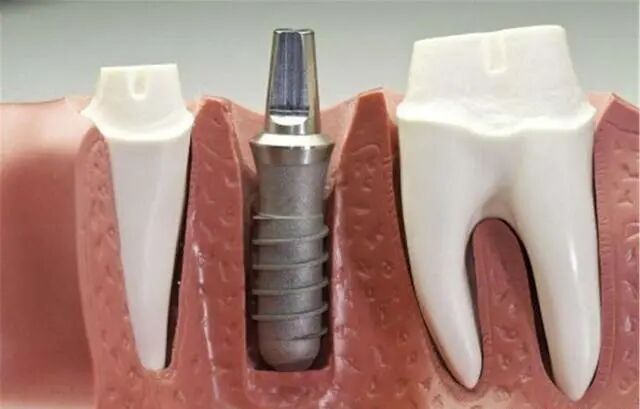 一颗“螺丝”就在嘴里下去了！你绝对没见过的种牙现场