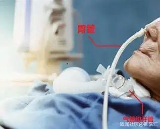 医用导管是干什么用的你知道导管的重要性吗？_https://www.jmylbn.com_新闻资讯_第10张