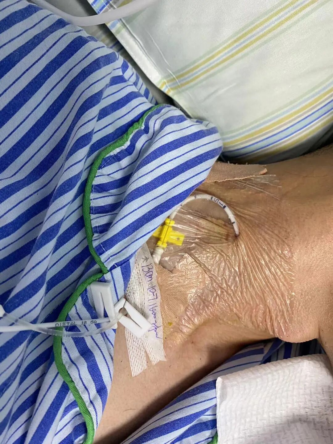 医用导管是干什么用的你知道导管的重要性吗？_https://www.jmylbn.com_新闻资讯_第20张