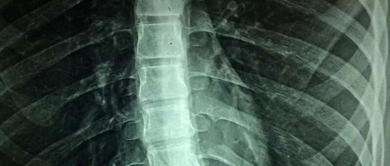 研究发现，脊髓损伤后无需药物就能控制血压