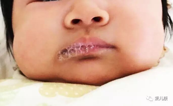 专家在线丨宝宝像螃蟹一样吐泡泡,是在"诉说"些什么?