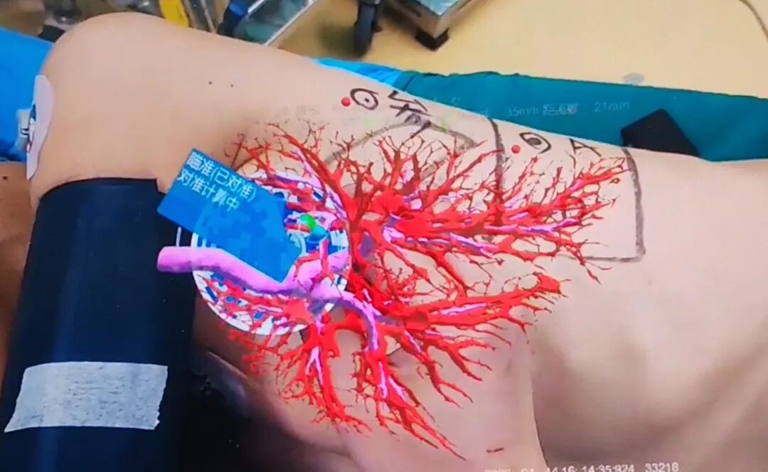 什么是数字肺肺结节看不见、摸不着？AI-AR导航帮你精准抓住它_https://www.jmylbn.com_新闻资讯_第5张
