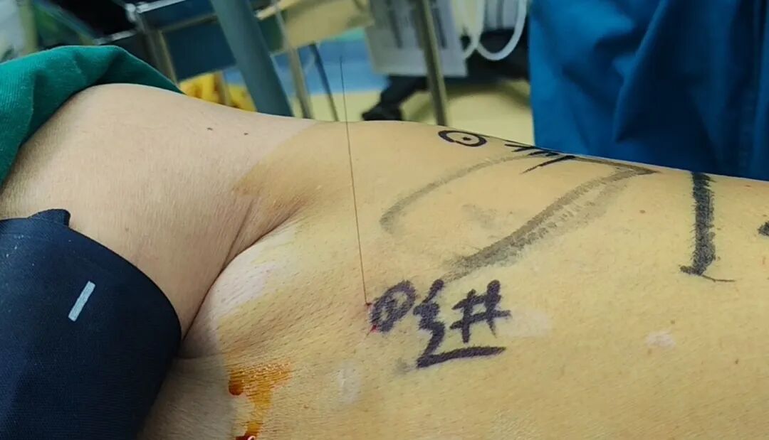 什么是数字肺肺结节看不见、摸不着？AI-AR导航帮你精准抓住它_https://www.jmylbn.com_新闻资讯_第7张