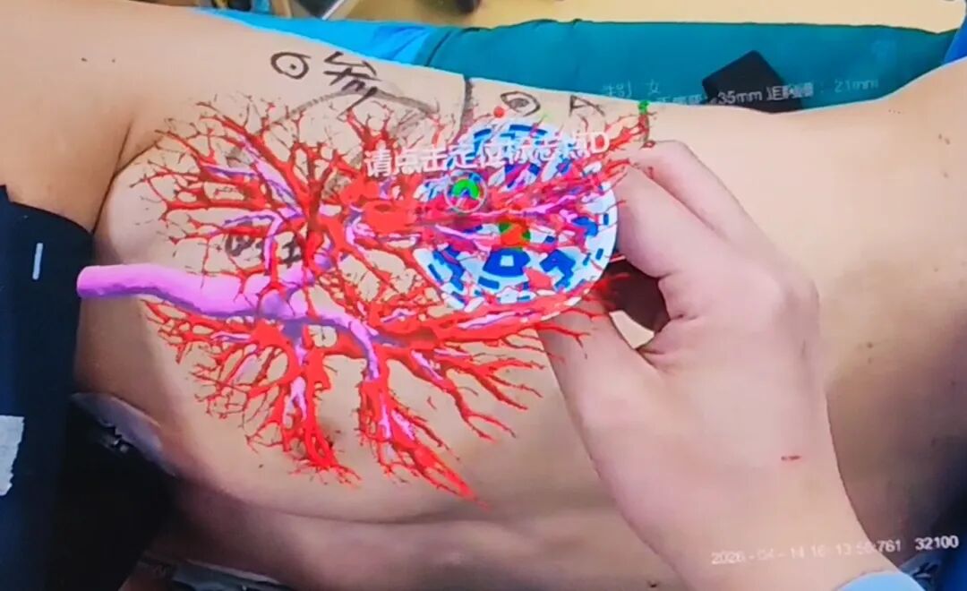 什么是数字肺肺结节看不见、摸不着？AI-AR导航帮你精准抓住它_https://www.jmylbn.com_新闻资讯_第4张