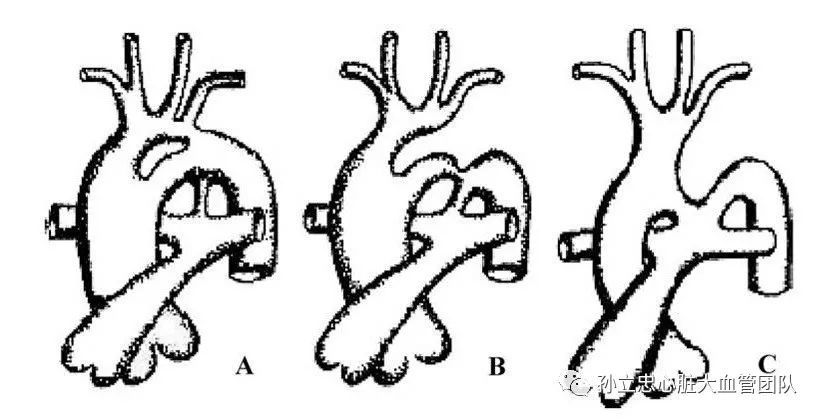 weinberg將該病分為三型:a型即雙腔主動脈弓,弓上血管起源於上方的第
