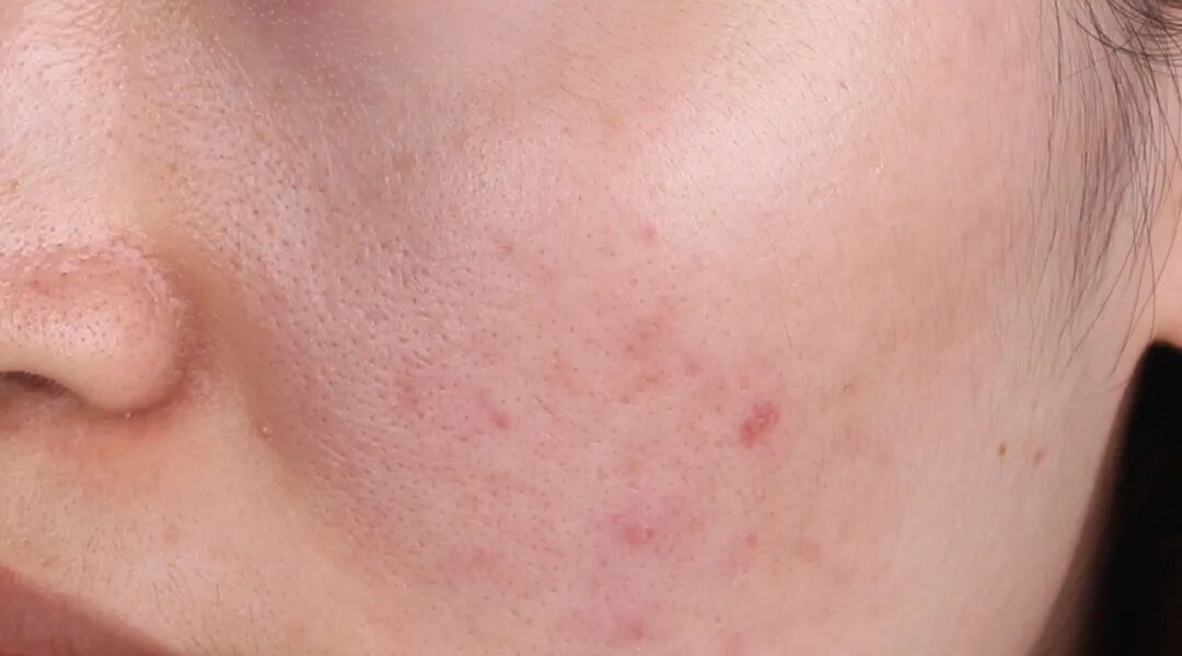 什么是屏障受损型毛孔粗大该如何治疗