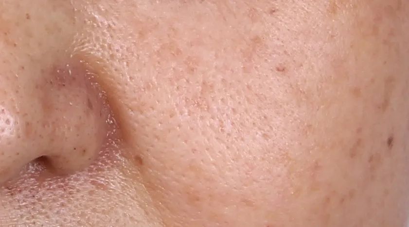 随着年龄增长,皮肤胶原蛋白逐渐流失,皮肤弹性逐渐下降,毛囊孔失去