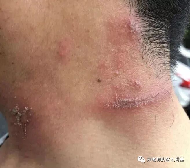 春末夏初正是"丘荨"发作期_丘疹性荨麻疹_症状表现_治疗方式 - 好大夫