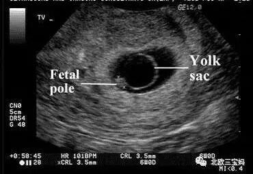 这次要命的宫外孕经历 重创了我的三胎梦 2 全网搜