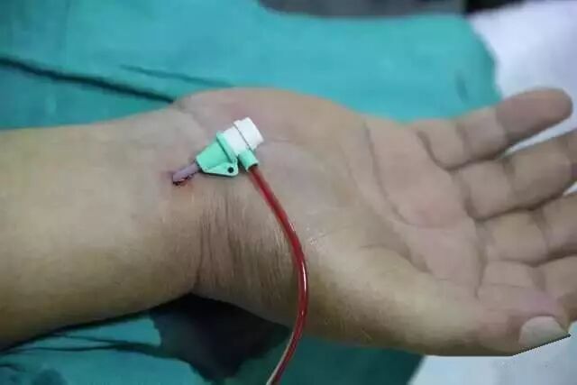 造影导丝是什么请看：这是心脏支架真实的样子_https://www.jmylbn.com_新闻资讯_第23张