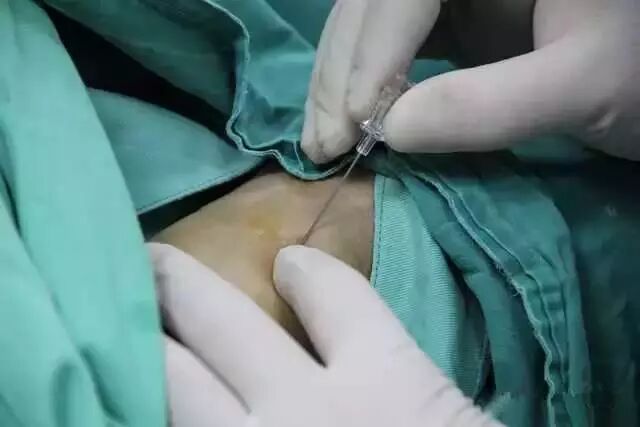 造影导丝是什么请看：这是心脏支架真实的样子_https://www.jmylbn.com_新闻资讯_第7张