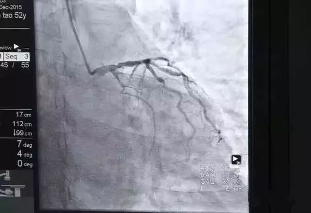 造影导丝是什么请看：这是心脏支架真实的样子_https://www.jmylbn.com_新闻资讯_第13张