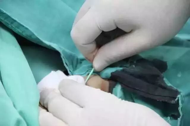 造影导丝是什么请看：这是心脏支架真实的样子_https://www.jmylbn.com_新闻资讯_第9张