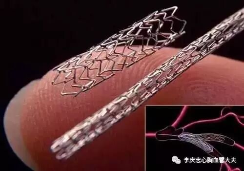 造影导丝是什么请看：这是心脏支架真实的样子_https://www.jmylbn.com_新闻资讯_第1张