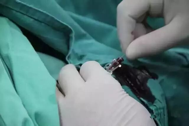 造影导丝是什么请看：这是心脏支架真实的样子_https://www.jmylbn.com_新闻资讯_第8张