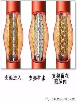 造影导丝是什么请看：这是心脏支架真实的样子_https://www.jmylbn.com_新闻资讯_第4张