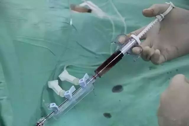 造影导丝是什么请看：这是心脏支架真实的样子_https://www.jmylbn.com_新闻资讯_第12张