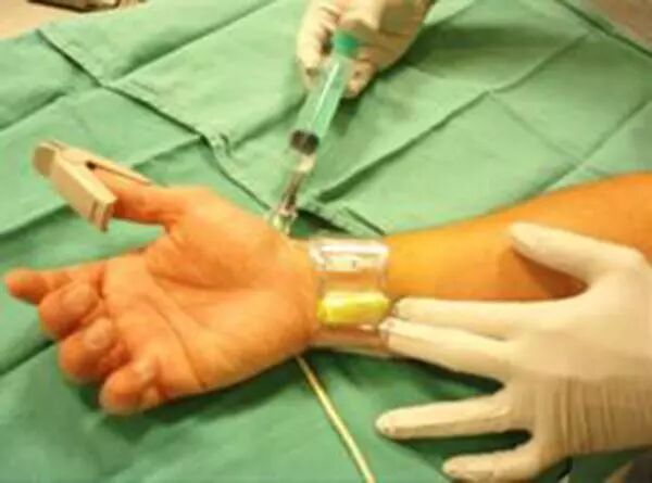 造影导丝是什么请看：这是心脏支架真实的样子_https://www.jmylbn.com_新闻资讯_第26张