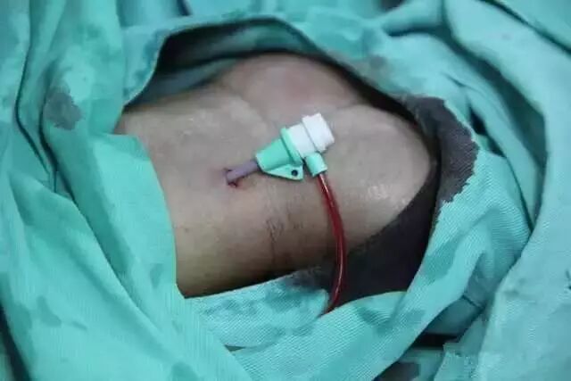 造影导丝是什么请看：这是心脏支架真实的样子_https://www.jmylbn.com_新闻资讯_第22张