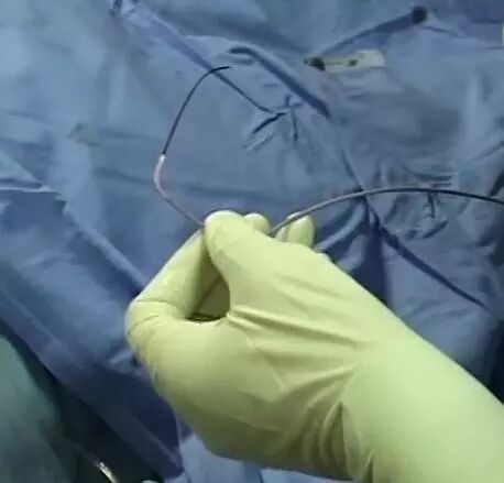 造影导丝是什么请看：这是心脏支架真实的样子_https://www.jmylbn.com_新闻资讯_第10张