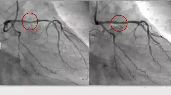 造影导丝是什么请看：这是心脏支架真实的样子_https://www.jmylbn.com_新闻资讯_第5张